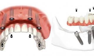 种植牙寿命 种植牙寿命